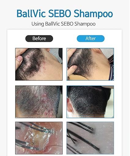 [ Ballvic ] Sebo Shampoo for Dandruff Treatment ( 17.6 oz )