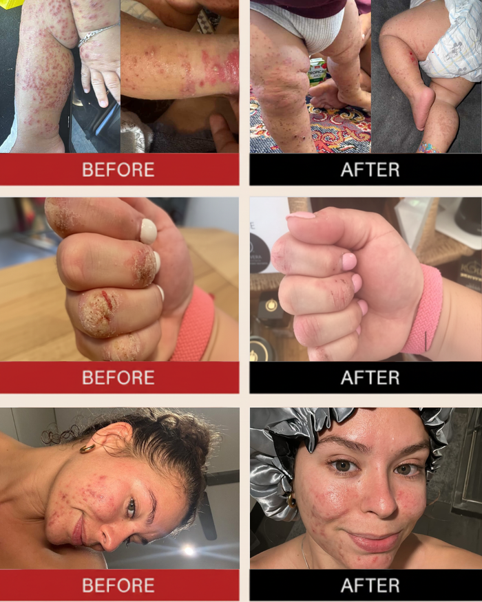 Eczema Less® Soap - Fragrance-Free | Colour-Free | 100% Australian Made